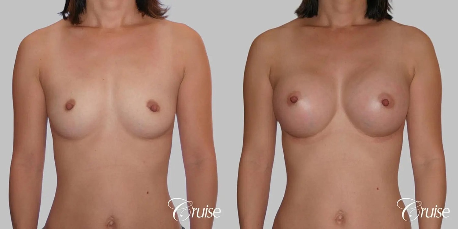 Breast Augmentation Before & After
