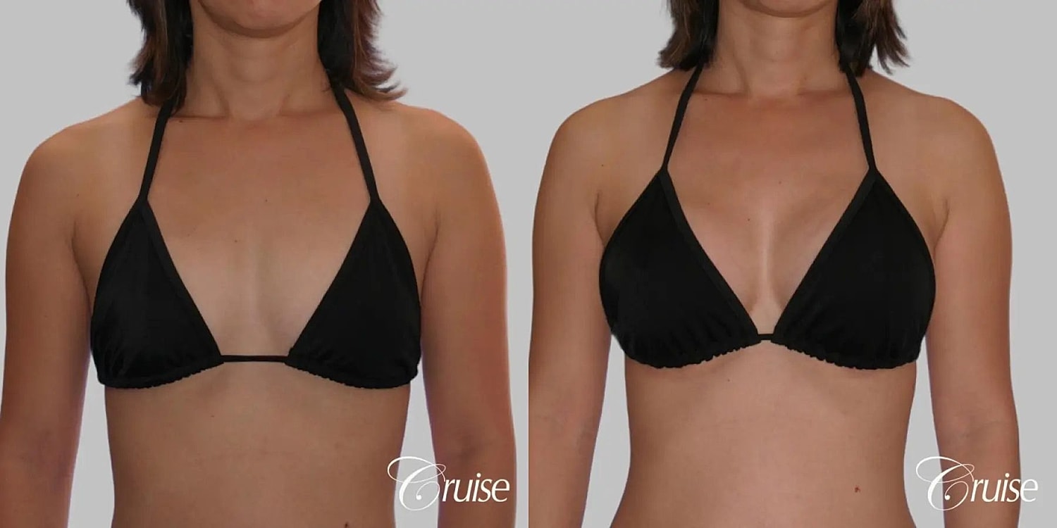 Breast Augmentation Before & After