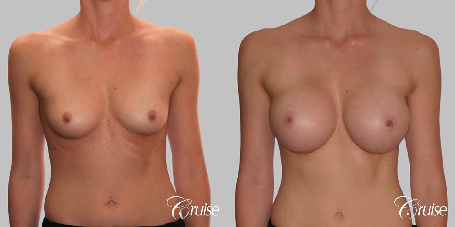 Breast Augmentation Before & After