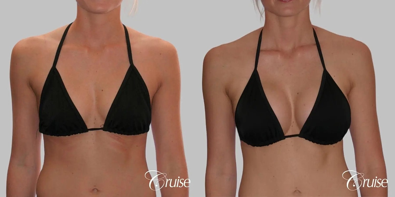 Breast Augmentation Before & After
