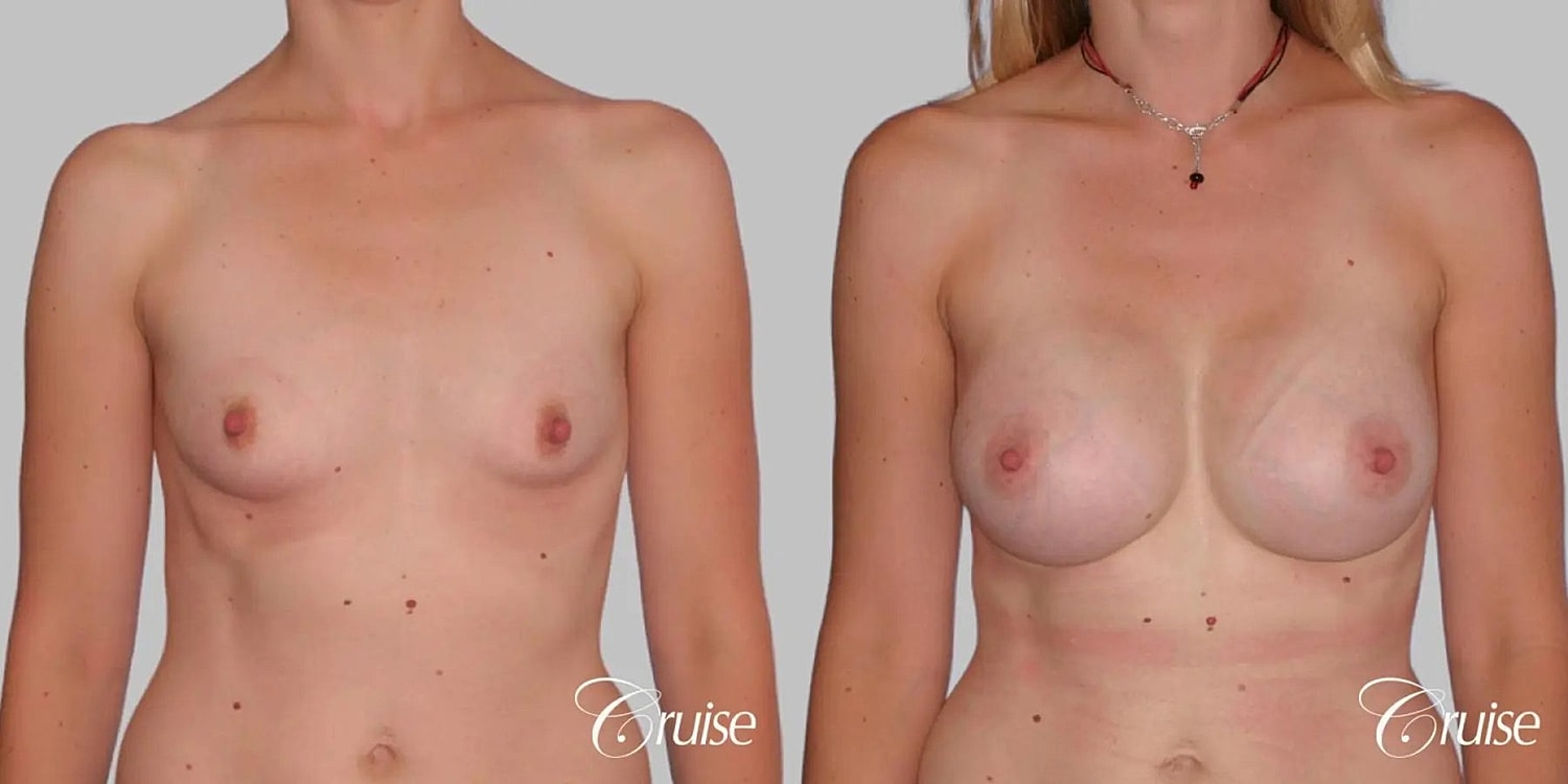 Breast Augmentation Before & After