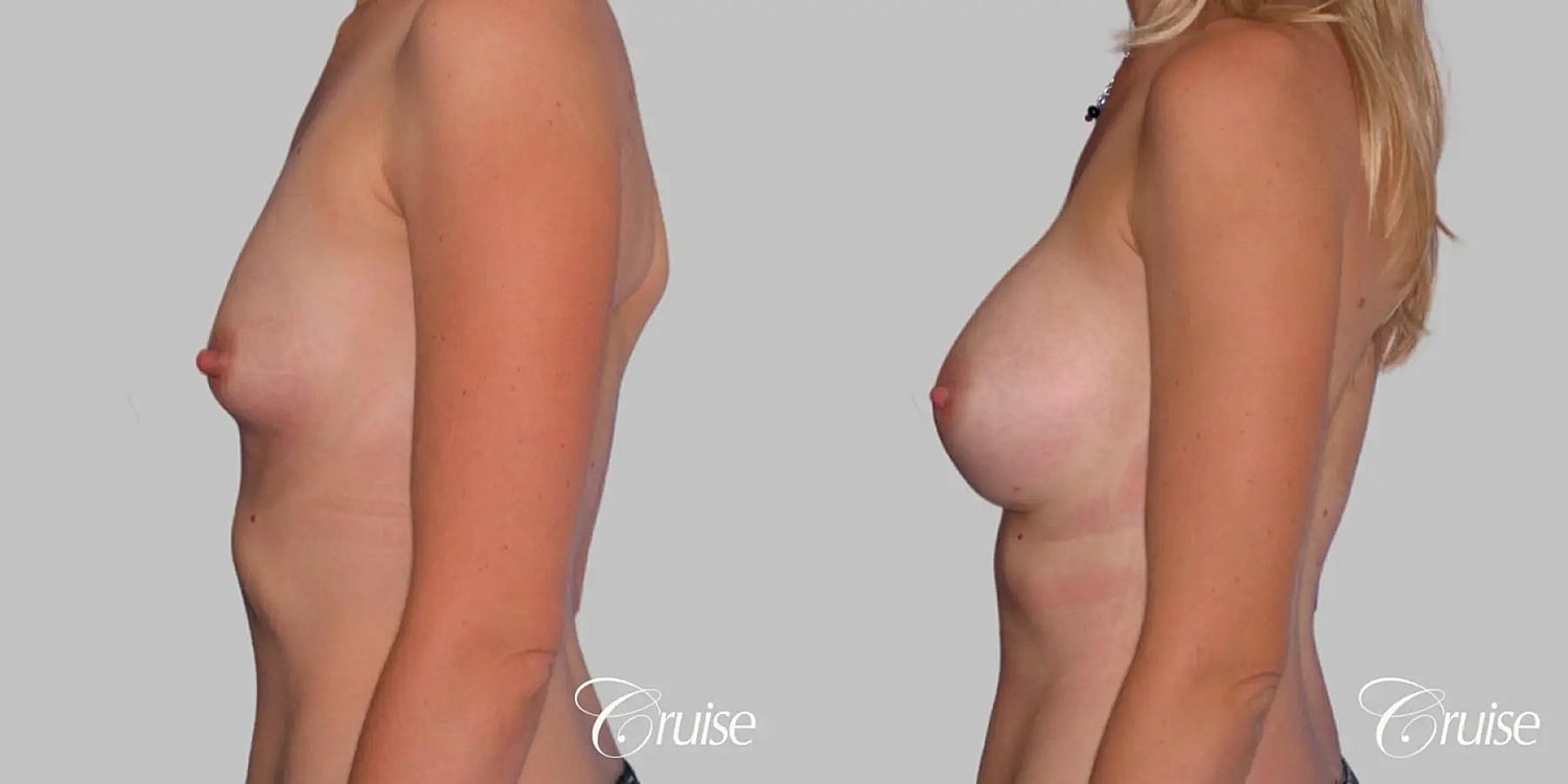 Breast Augmentation Before & After