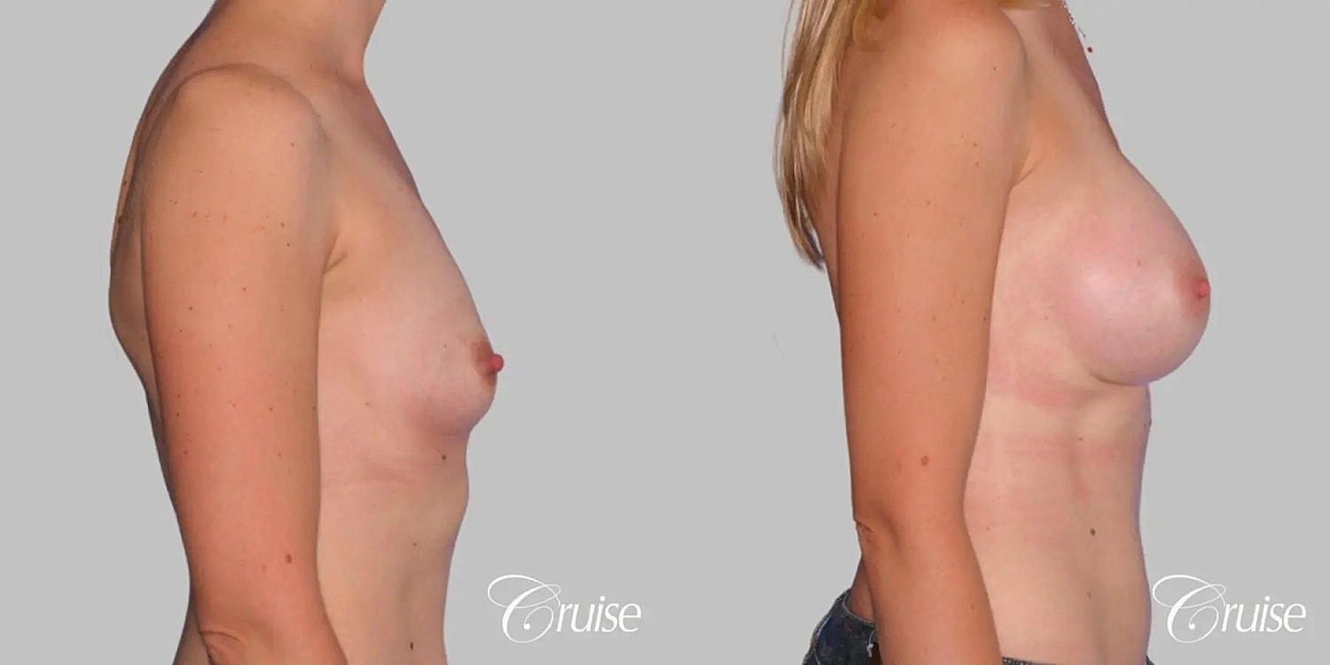 Breast Augmentation Before & After
