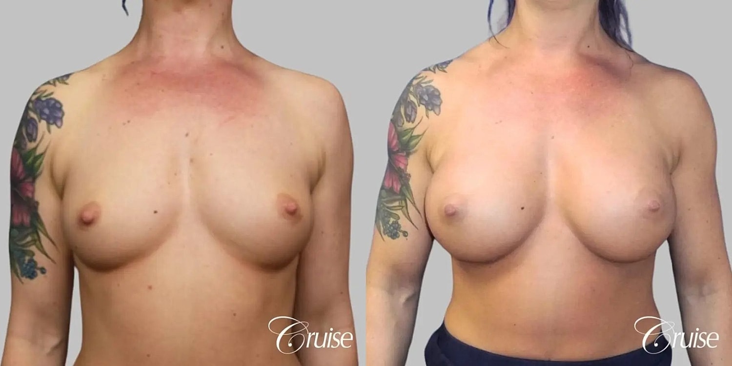 Breast Augmentation Before & After
