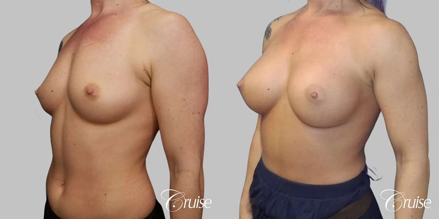 Breast Augmentation Before & After