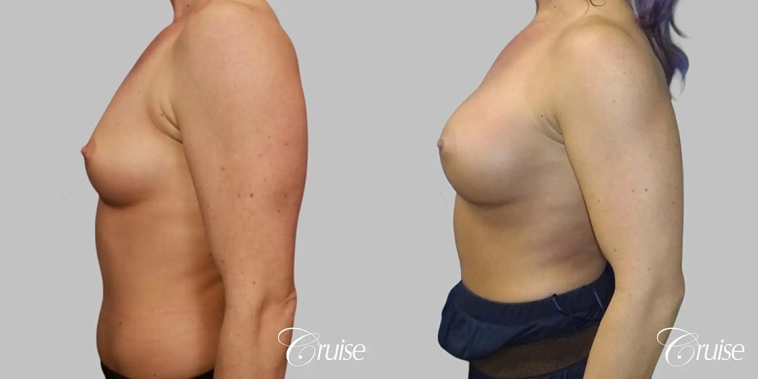 Breast Augmentation Before & After