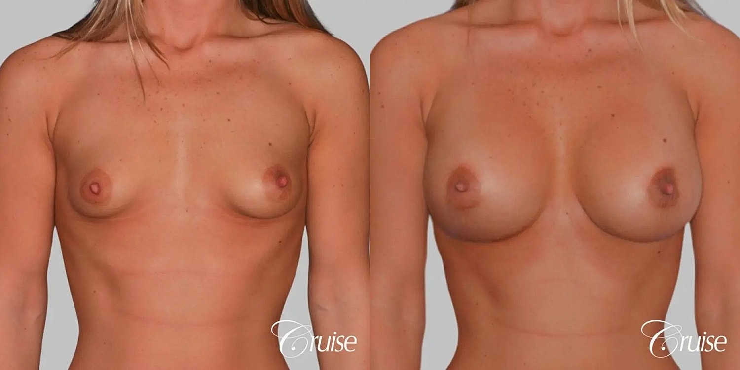 Breast Augmentation Before & After