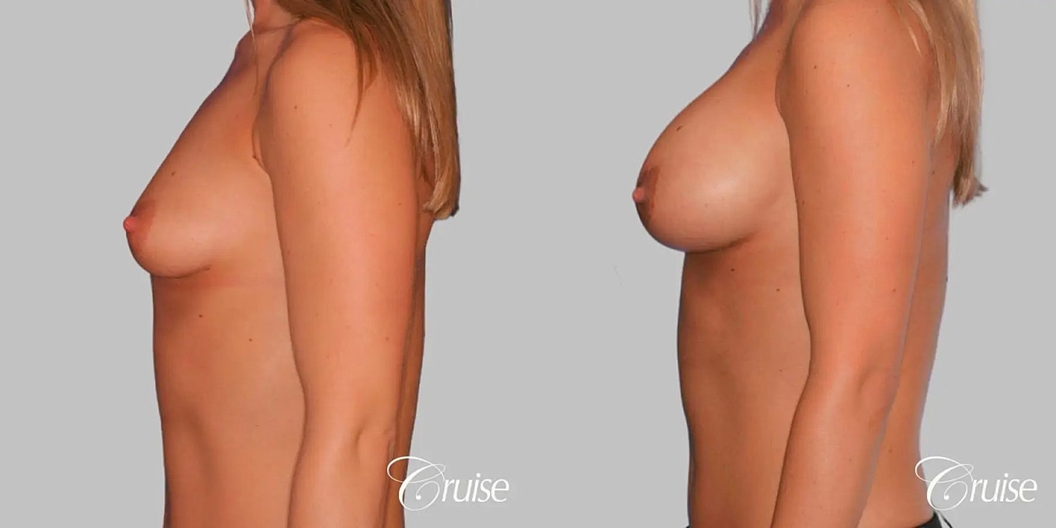 Breast Augmentation Before & After