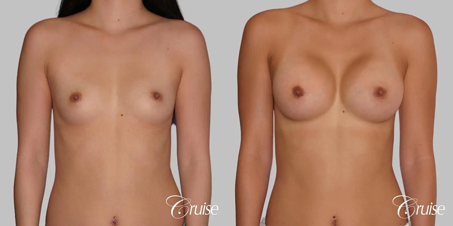 Breast Augmentation Before & After