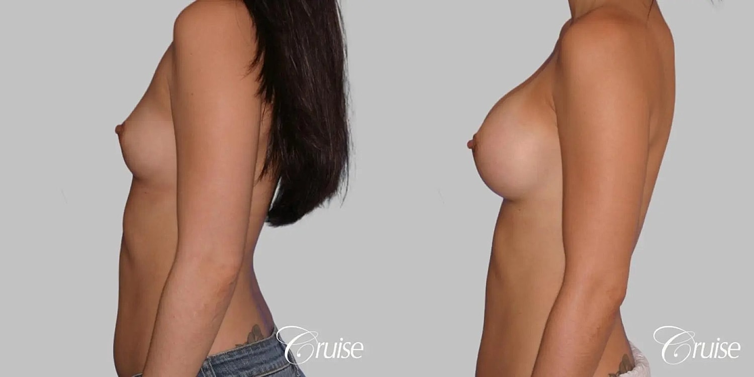 Breast Augmentation Before & After