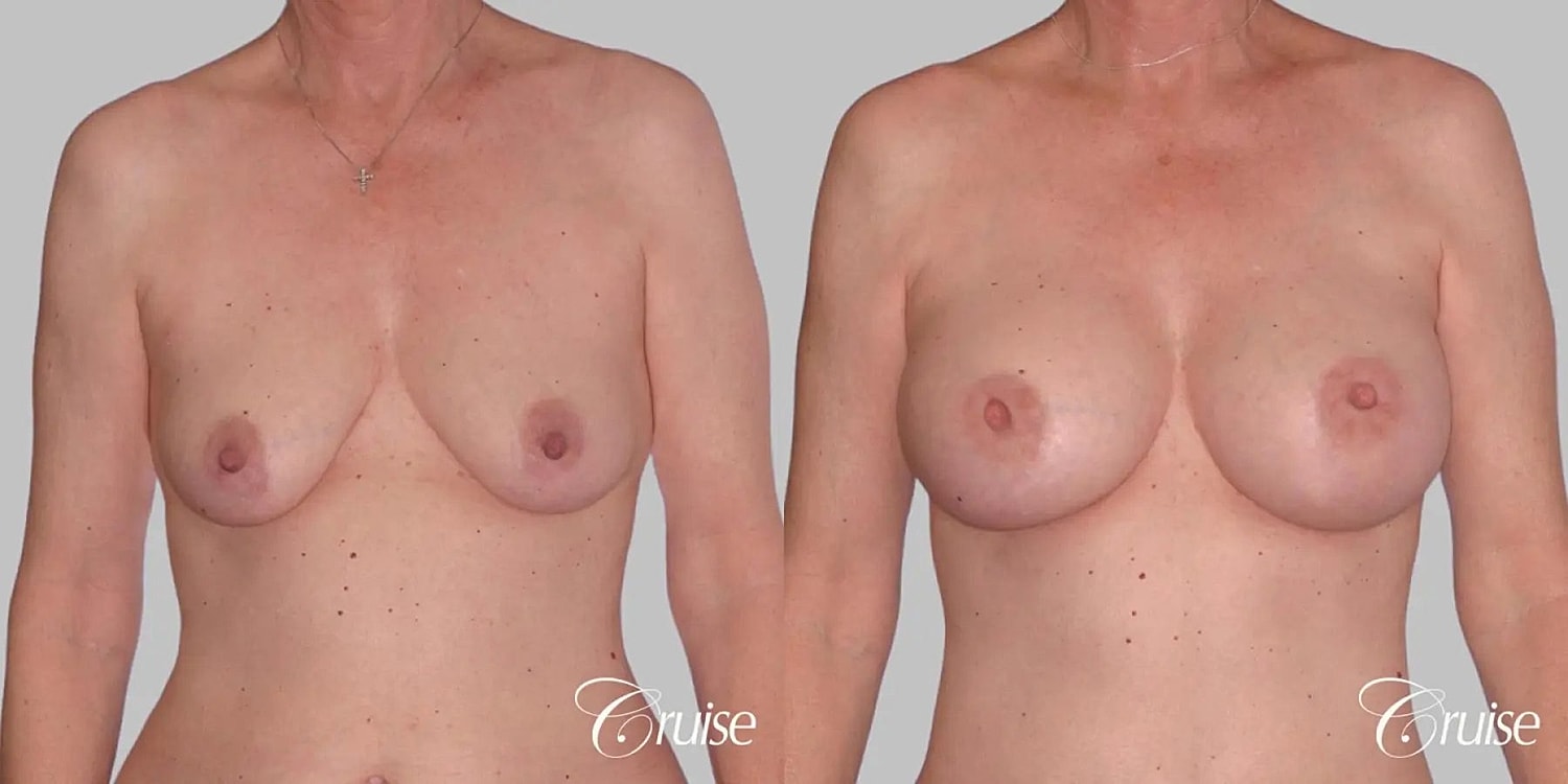 Breast Augmentation Before & After