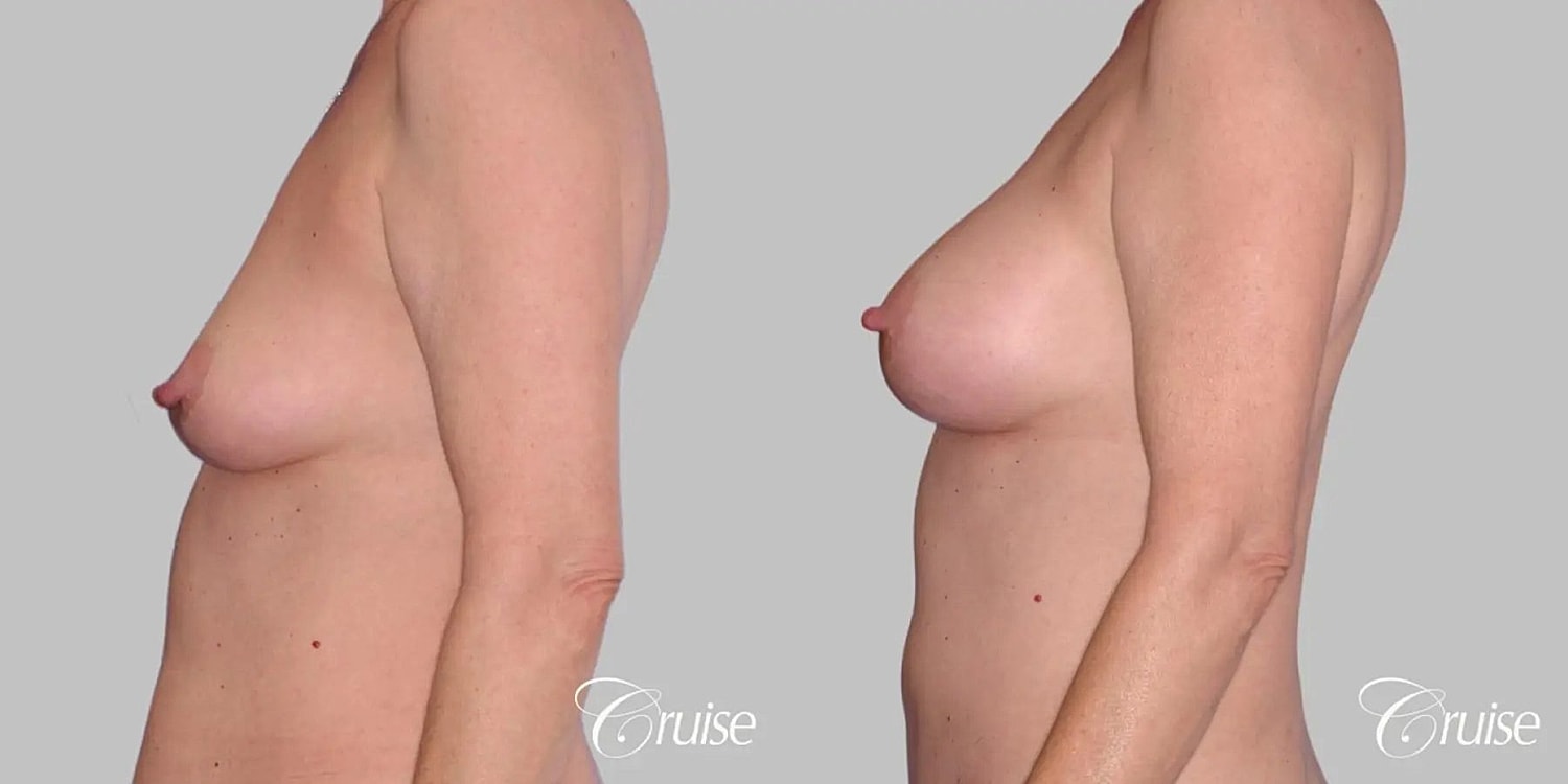 Breast Augmentation Before & After