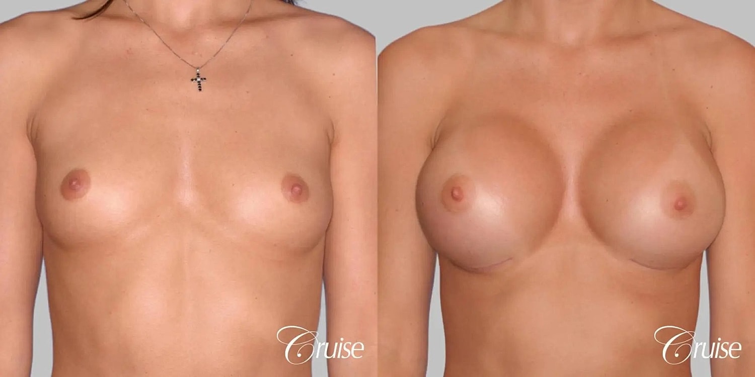 Breast Augmentation Before & After
