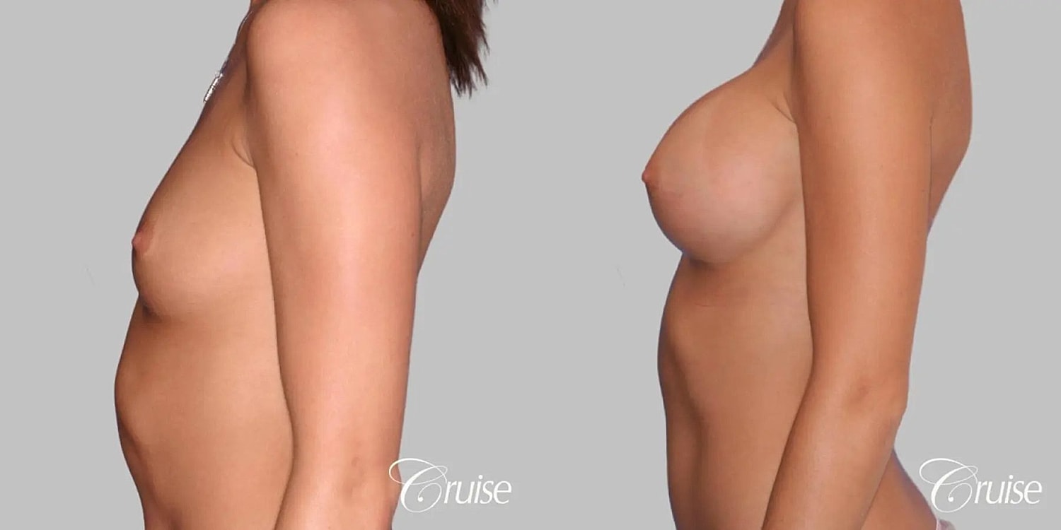 Breast Augmentation Before & After
