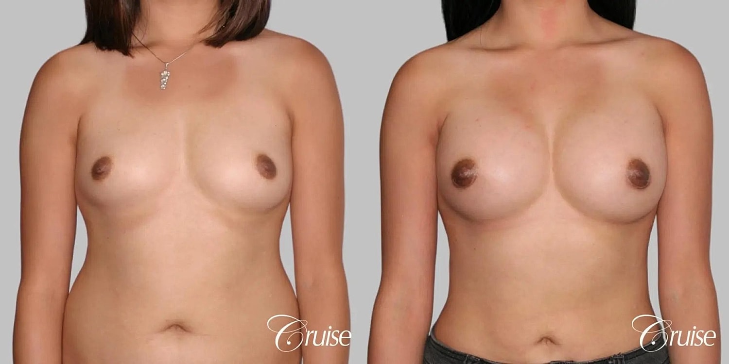 Breast Augmentation Before & After