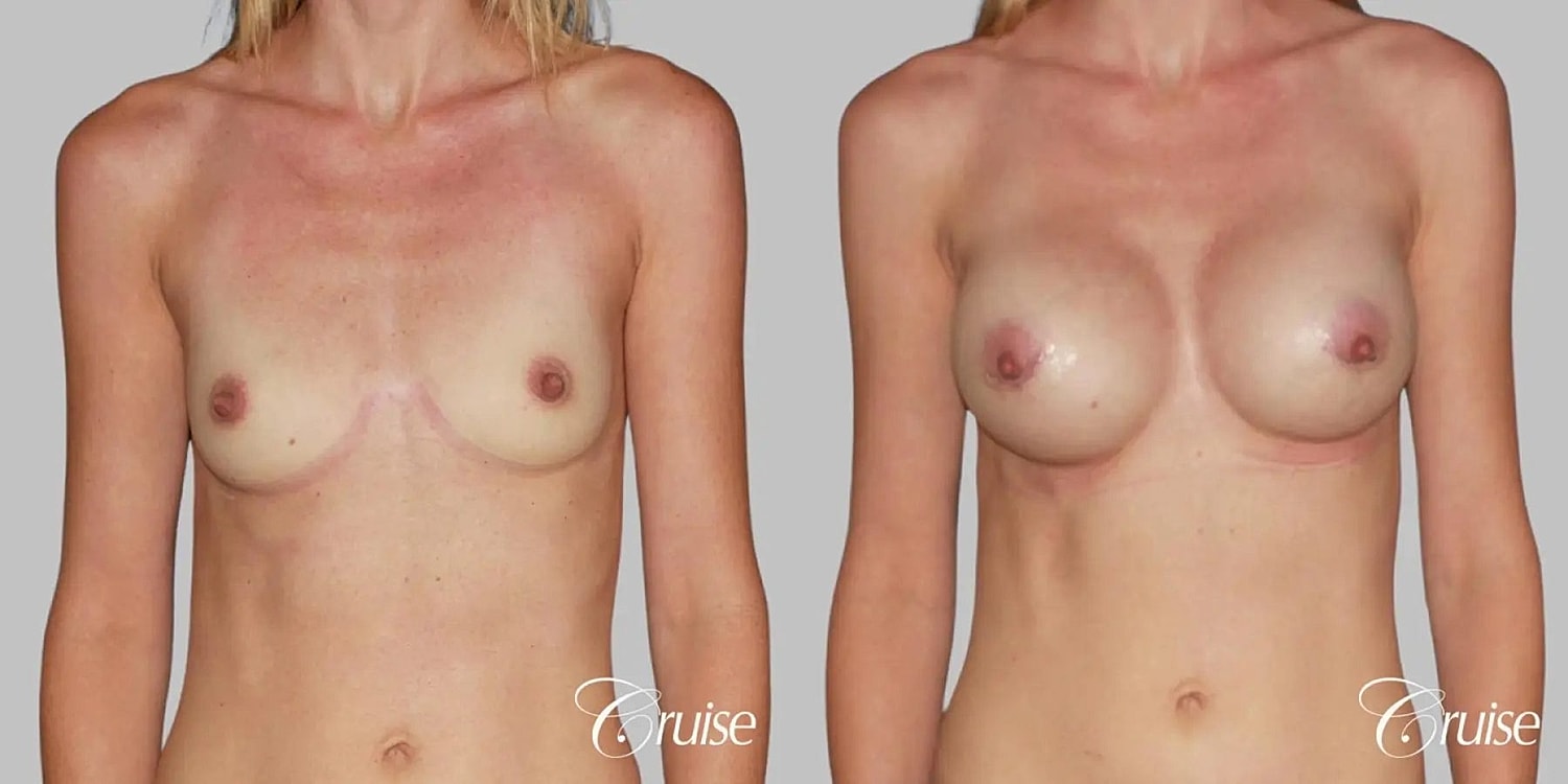 Breast Augmentation Before & After