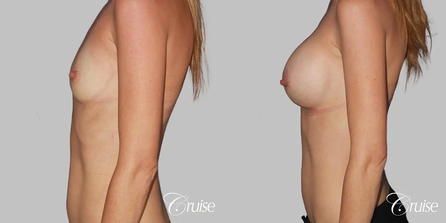 Breast Augmentation Before & After