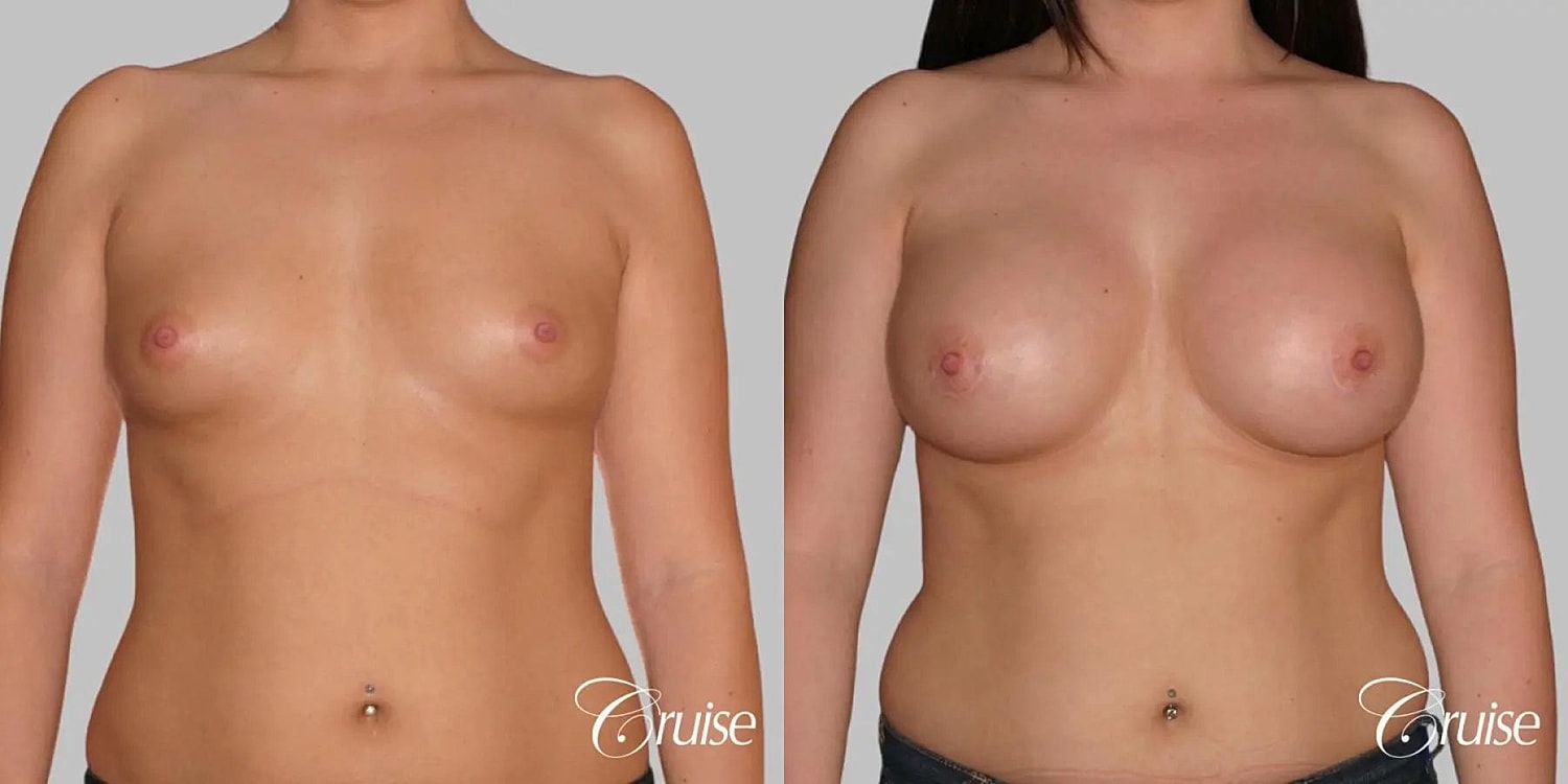 Breast Augmentation Before & After