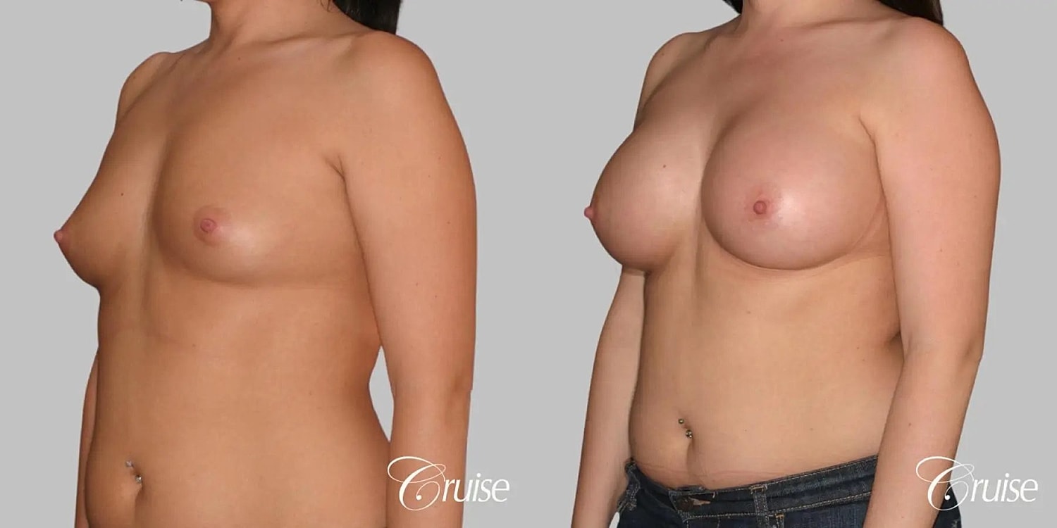 Breast Augmentation Before & After