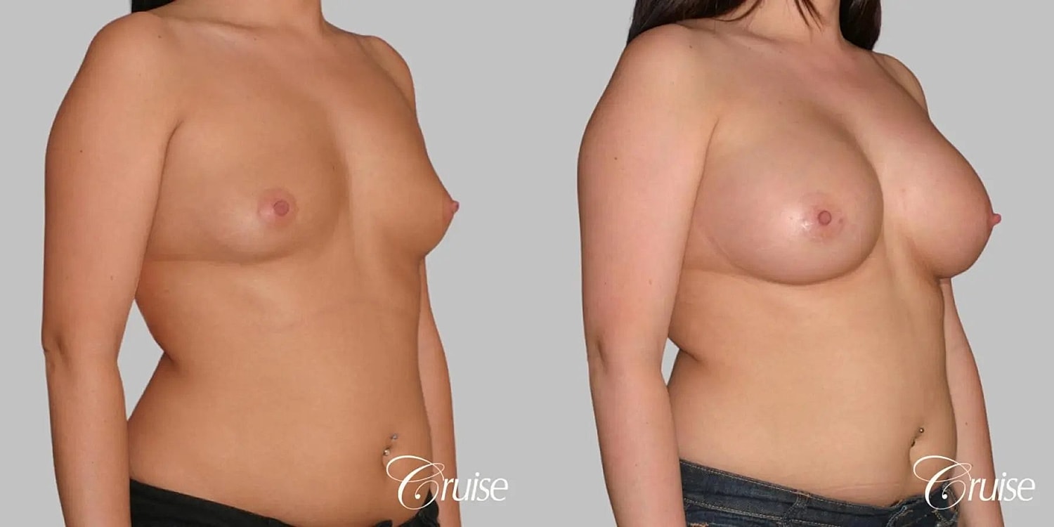 Breast Augmentation Before & After