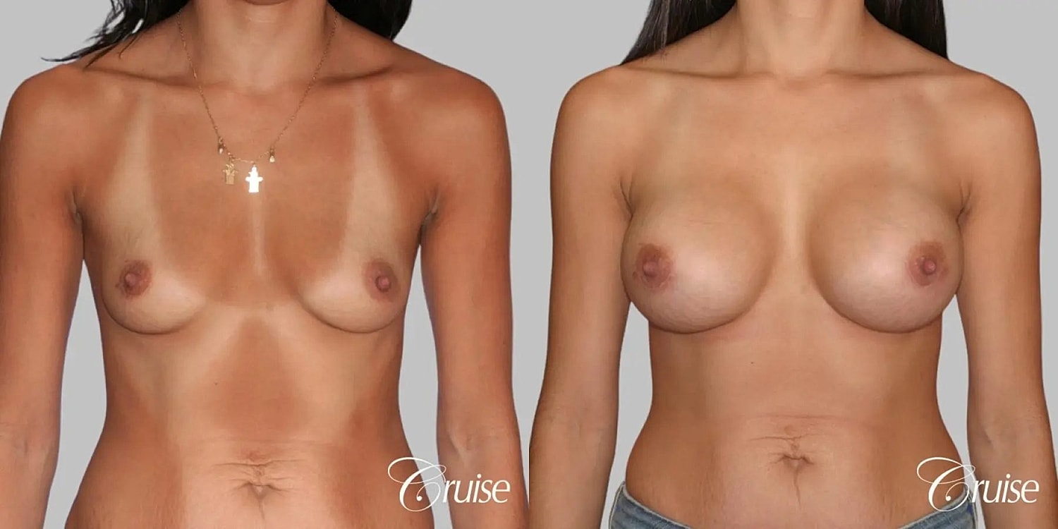 Breast Augmentation Before & After