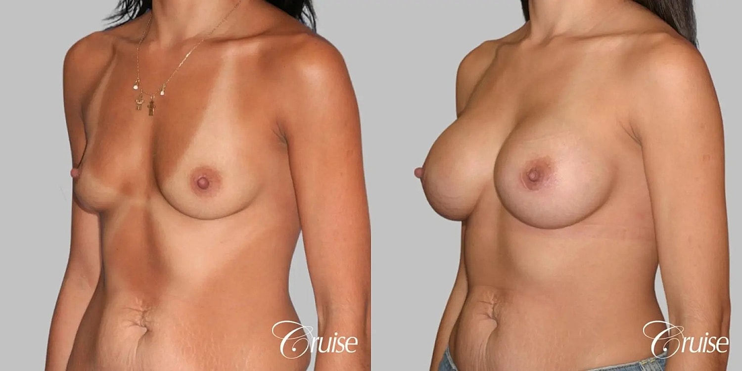 Breast Augmentation Before & After