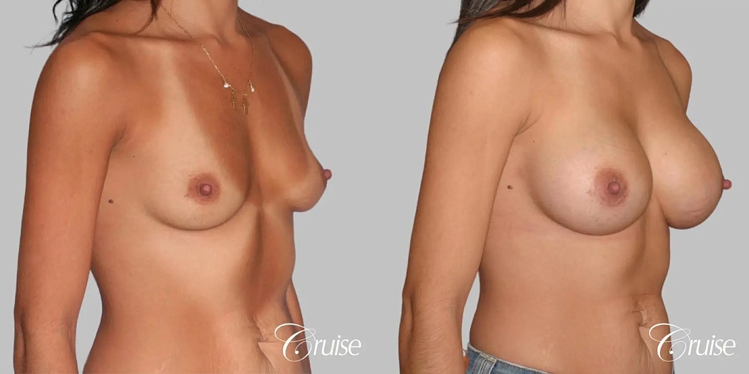 Breast Augmentation Before & After