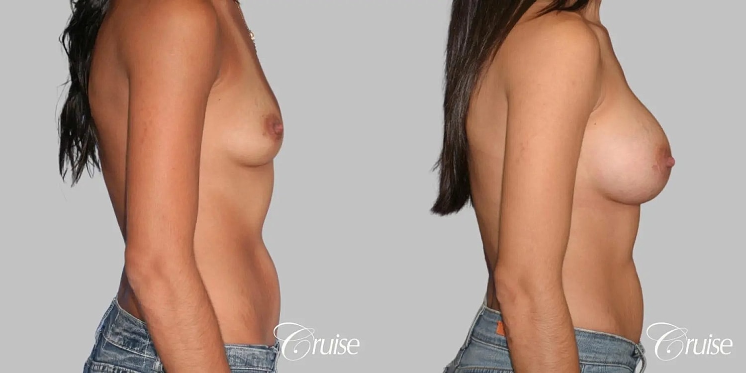 Breast Augmentation Before & After