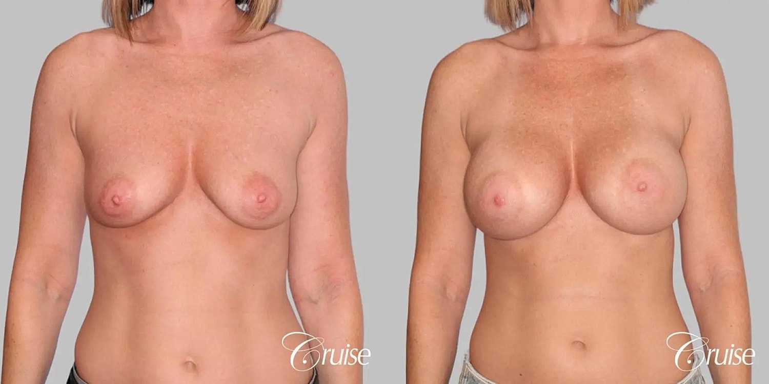Breast Augmentation Before & After