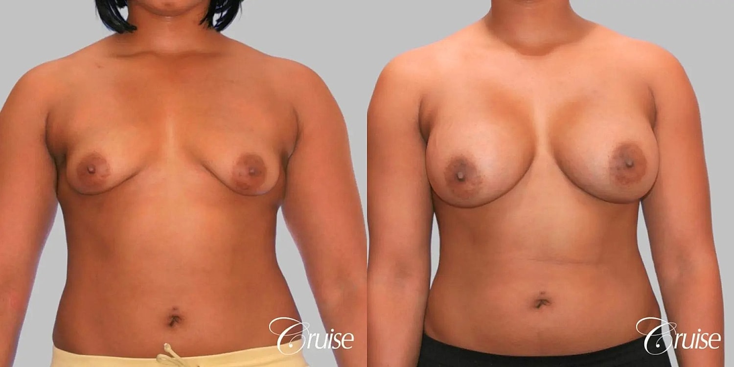 Breast Augmentation Before & After