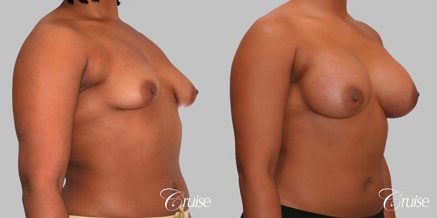 Breast Augmentation Before & After