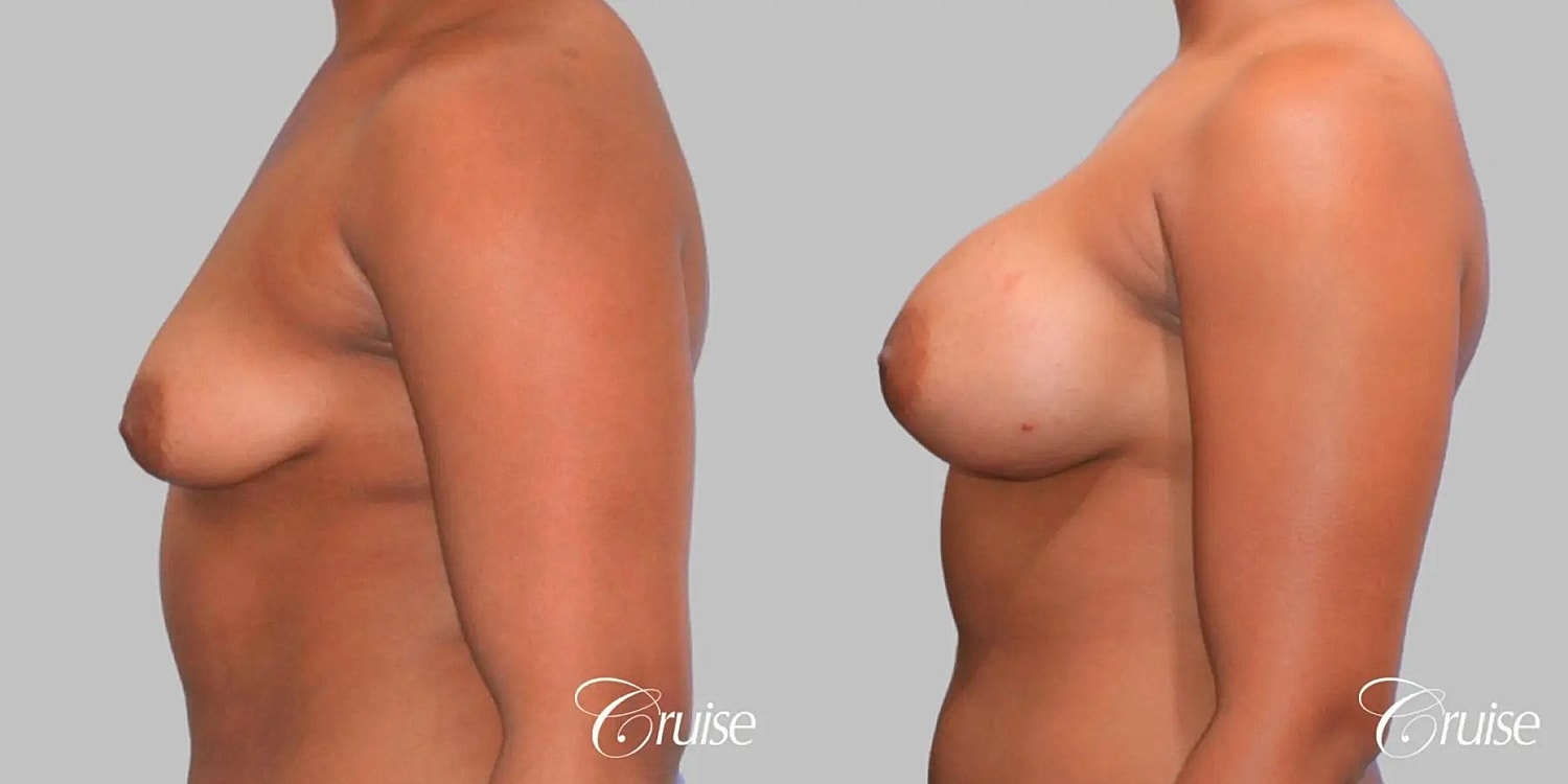 Breast Augmentation Before & After