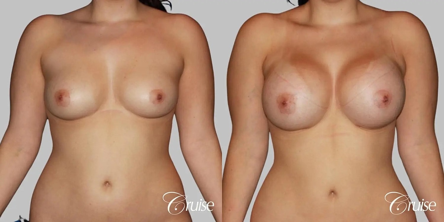 Breast Augmentation Before & After
