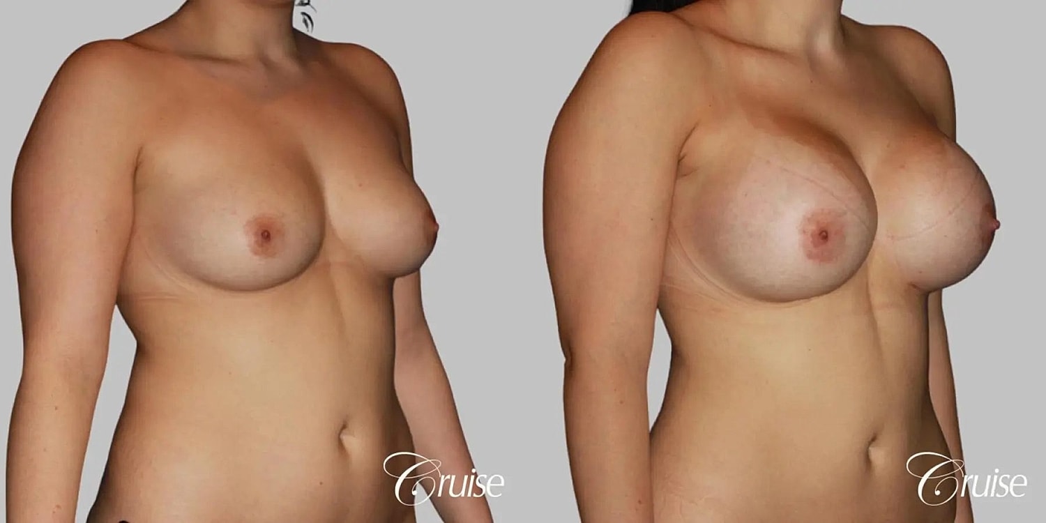 Breast Augmentation Before & After