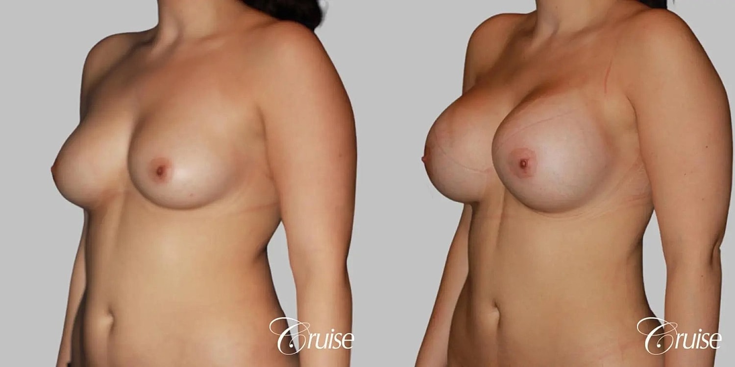 Breast Augmentation Before & After