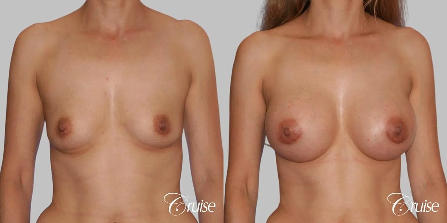 Breast Augmentation Before & After