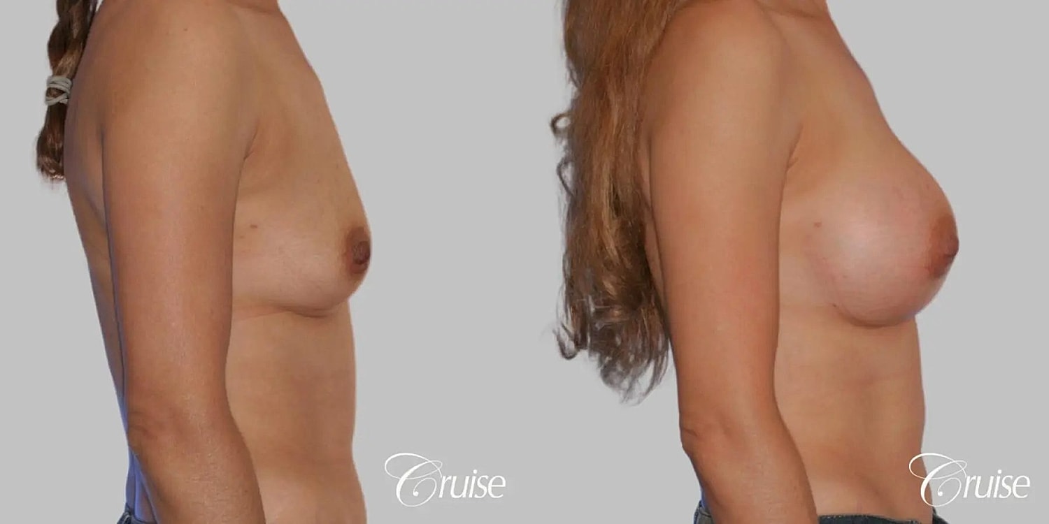Breast Augmentation Before & After
