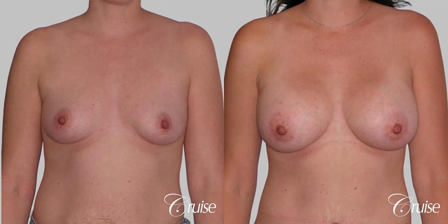 Breast Augmentation Before & After