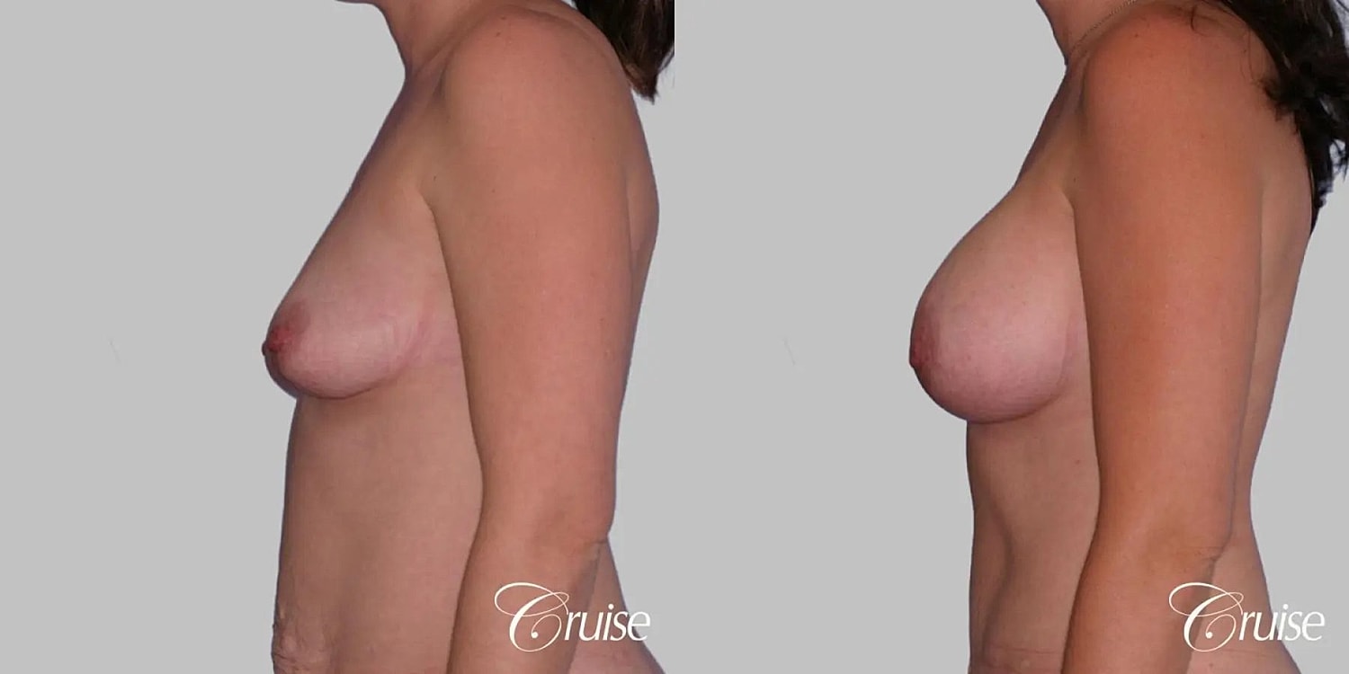 Breast Augmentation Before & After