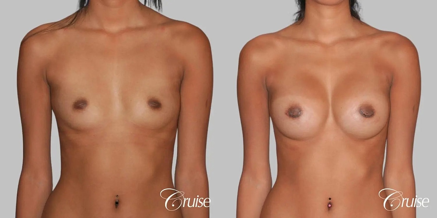 Breast Augmentation Before & After