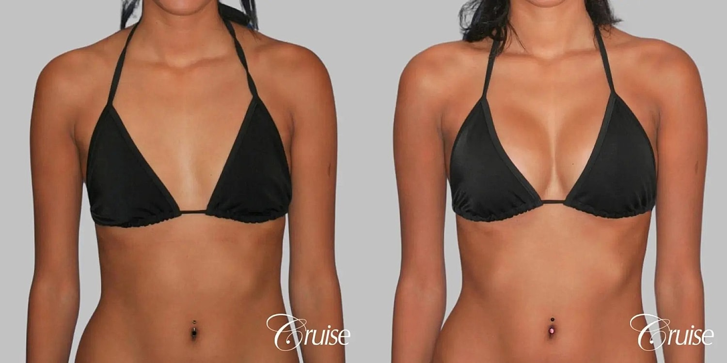 Breast Augmentation Before & After