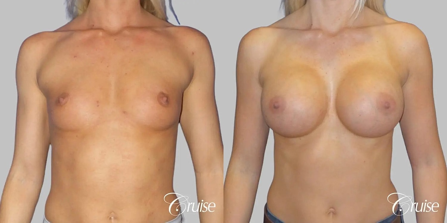Breast Augmentation Before & After