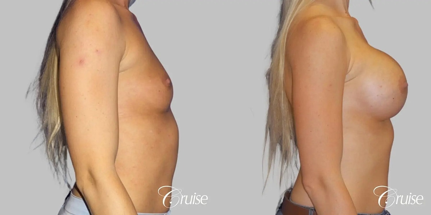 Breast Augmentation Before & After
