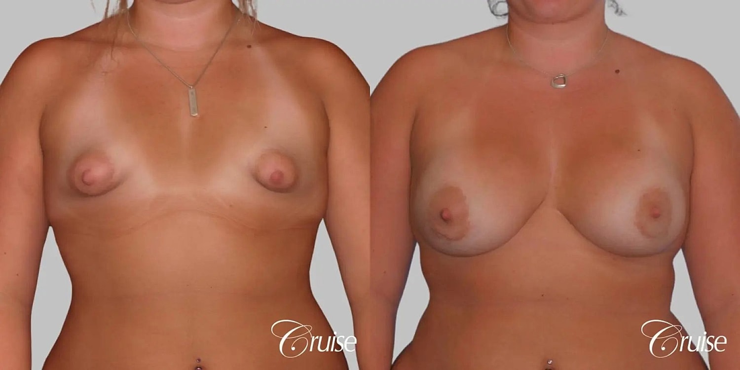 Breast Augmentation Before & After