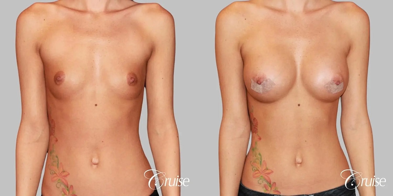 Breast Augmentation Before & After