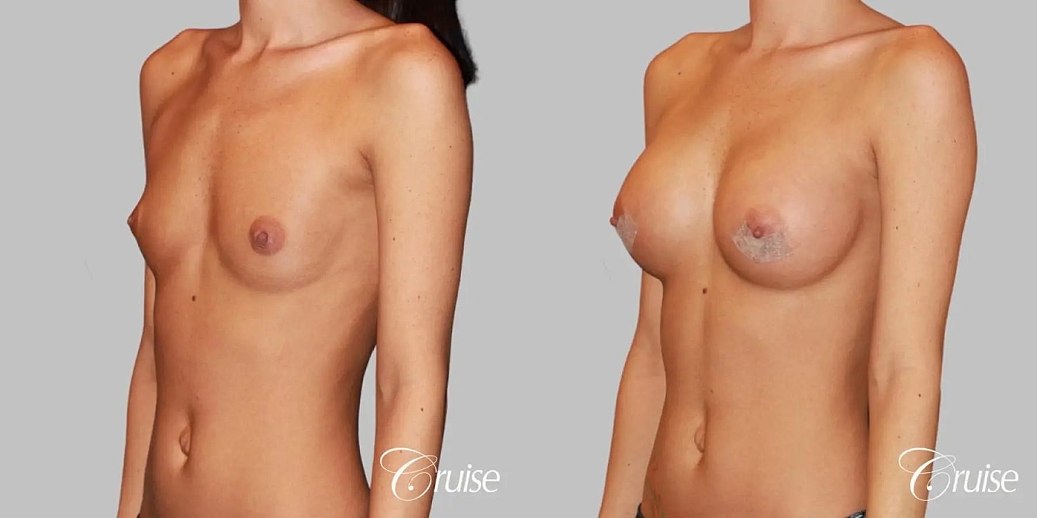 Breast Augmentation Before & After