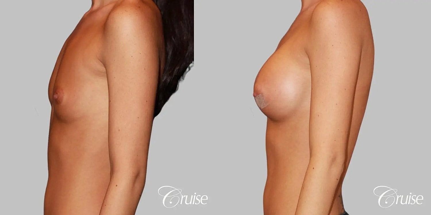 Breast Augmentation Before & After