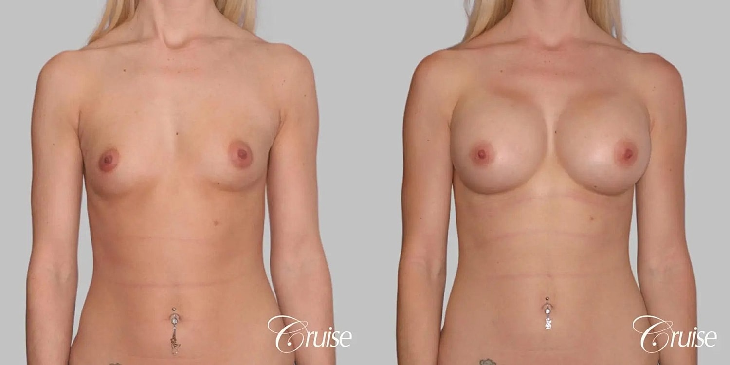 Breast Augmentation Before & After