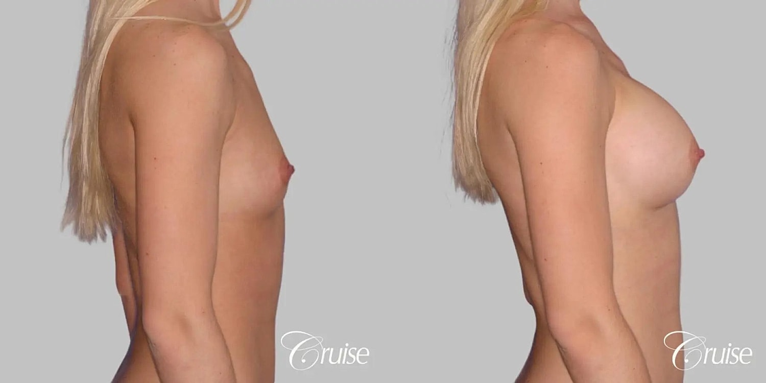Breast Augmentation Before & After