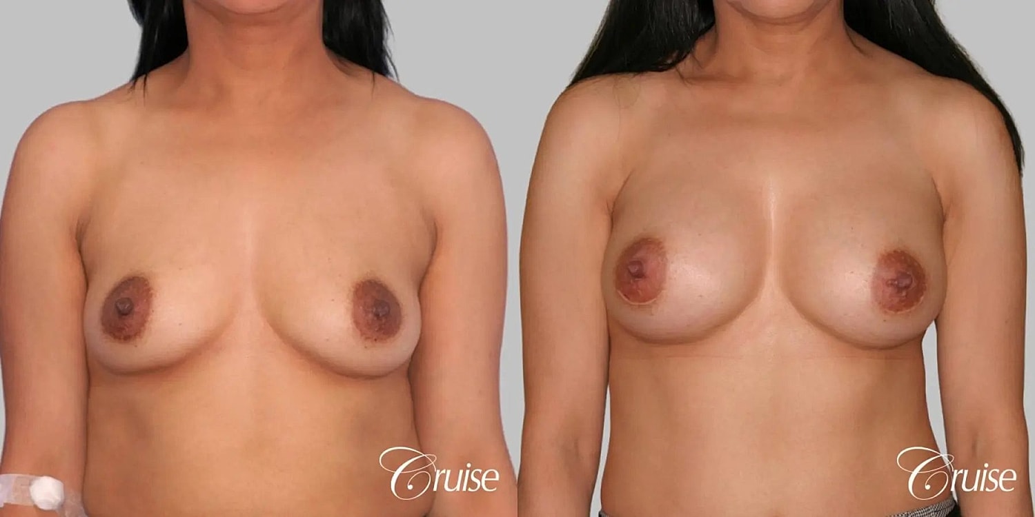Breast Augmentation Before & After
